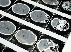 entenda-o-que-e-o-donanemabe,-o-medicamento-aprovado-para-tratamento-de-alzheimer-no-brasil